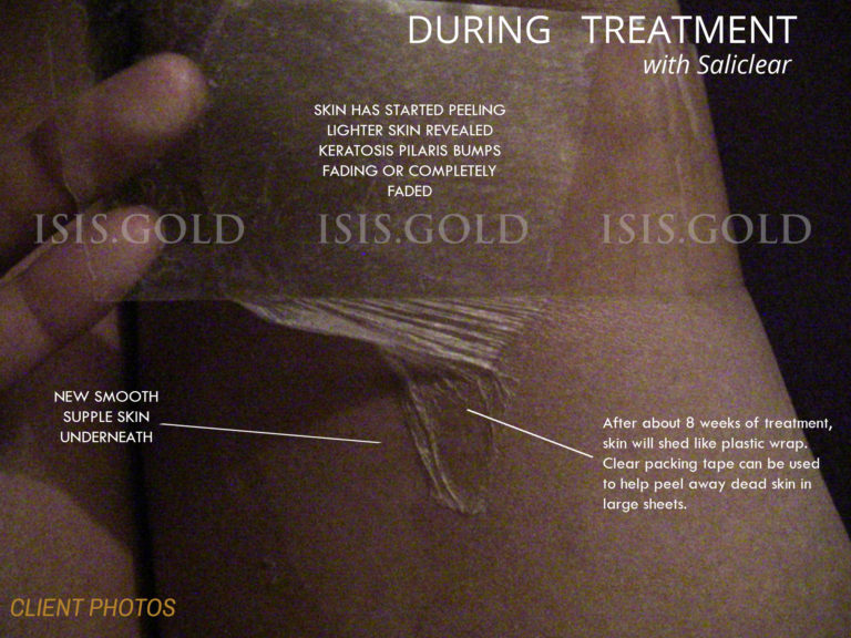 TAPE METHOD HOW TO REMOVE ALL THOSE PEELING FLAKES » Best Skincare and