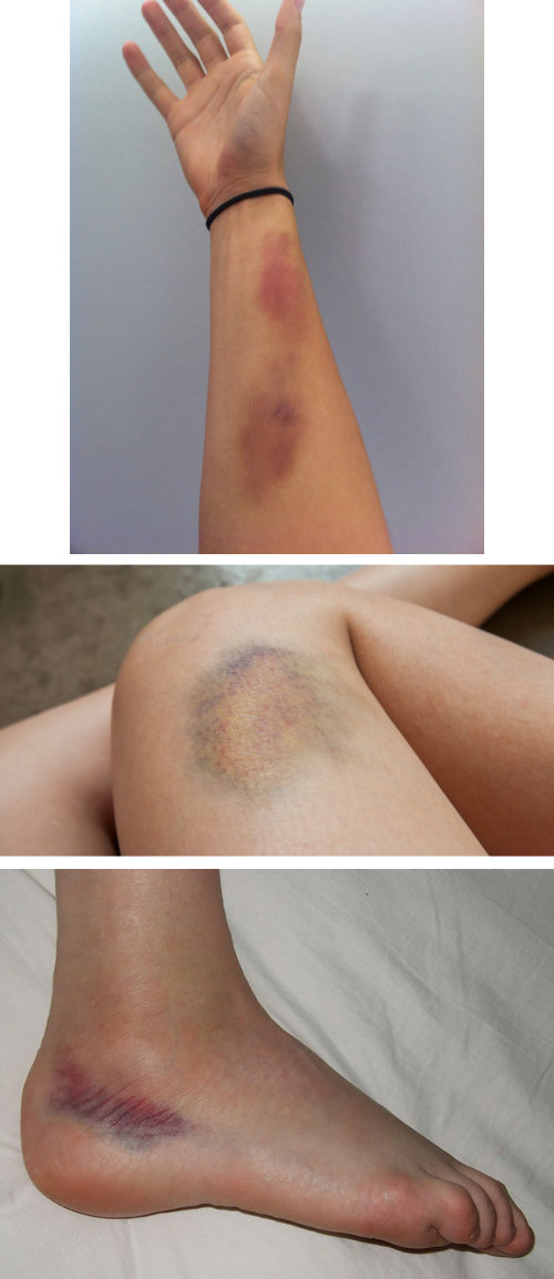 bruises, skin whitening, skin bleaching, skin lightening