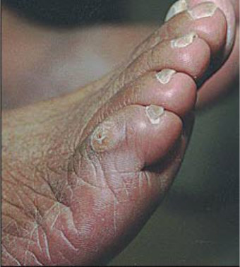 fix ugly feet, repair ugly feet