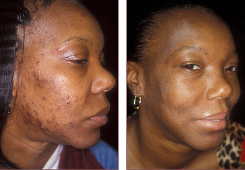 TCA Peel Before & After