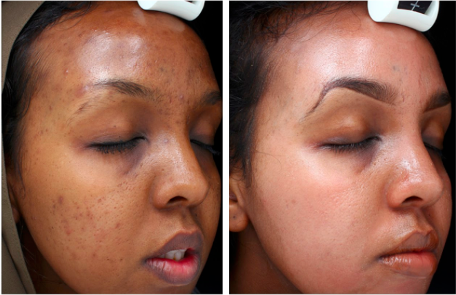 TCA Peel Before & After