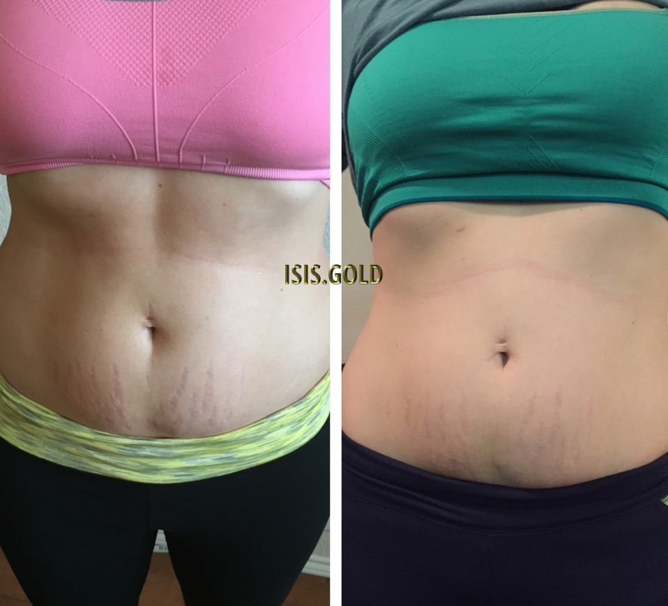 woman with stretchmarks on belly before and after stretch marks removal