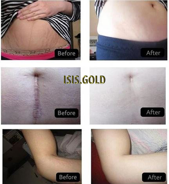 Caucasian woman with stretch marks on her belly before and after, scar removal, stretch marks before and after, how to get rid of stretch marks, stretch marks removal, stretch mark treatment