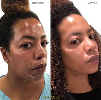 african american black female woman with peeling skin around her mouth after a tca chemical peel and showing after her skin healed