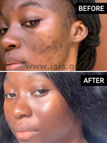 tranexamic acid serum