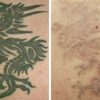 TCA Peel: Tattoo Removal TCA Peel: Tattoo Removal