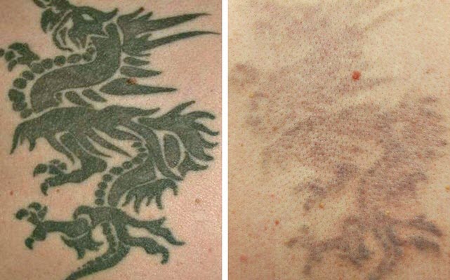 TCA Peel: Tattoo Removal