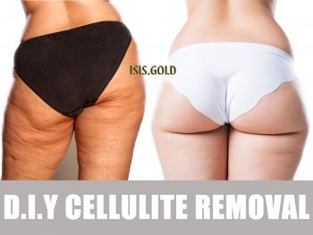 CELLULITE