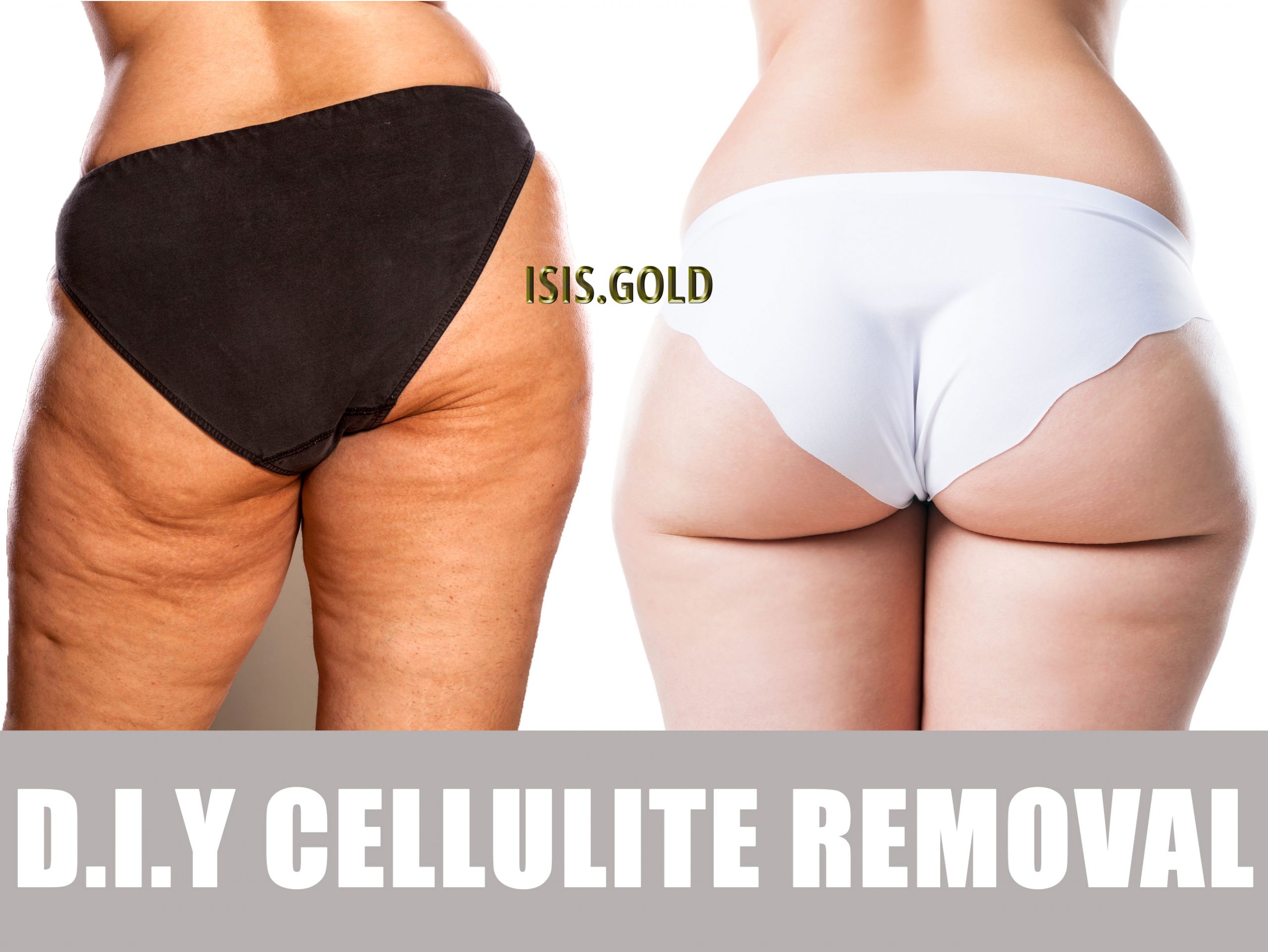 cellulite removalbefore and after, cellulite removal, cellulite treatment, best cellulite treatment, cellulite reduction, cellulite on legs,get rid of cellulite, goodbye cellulite, cellulite creams, anti cellulite,severe cellulite, cellulite on thighs, cellulite treatment near me