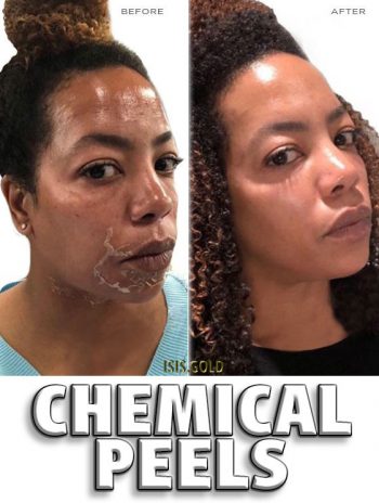 CHEMICAL PEELS