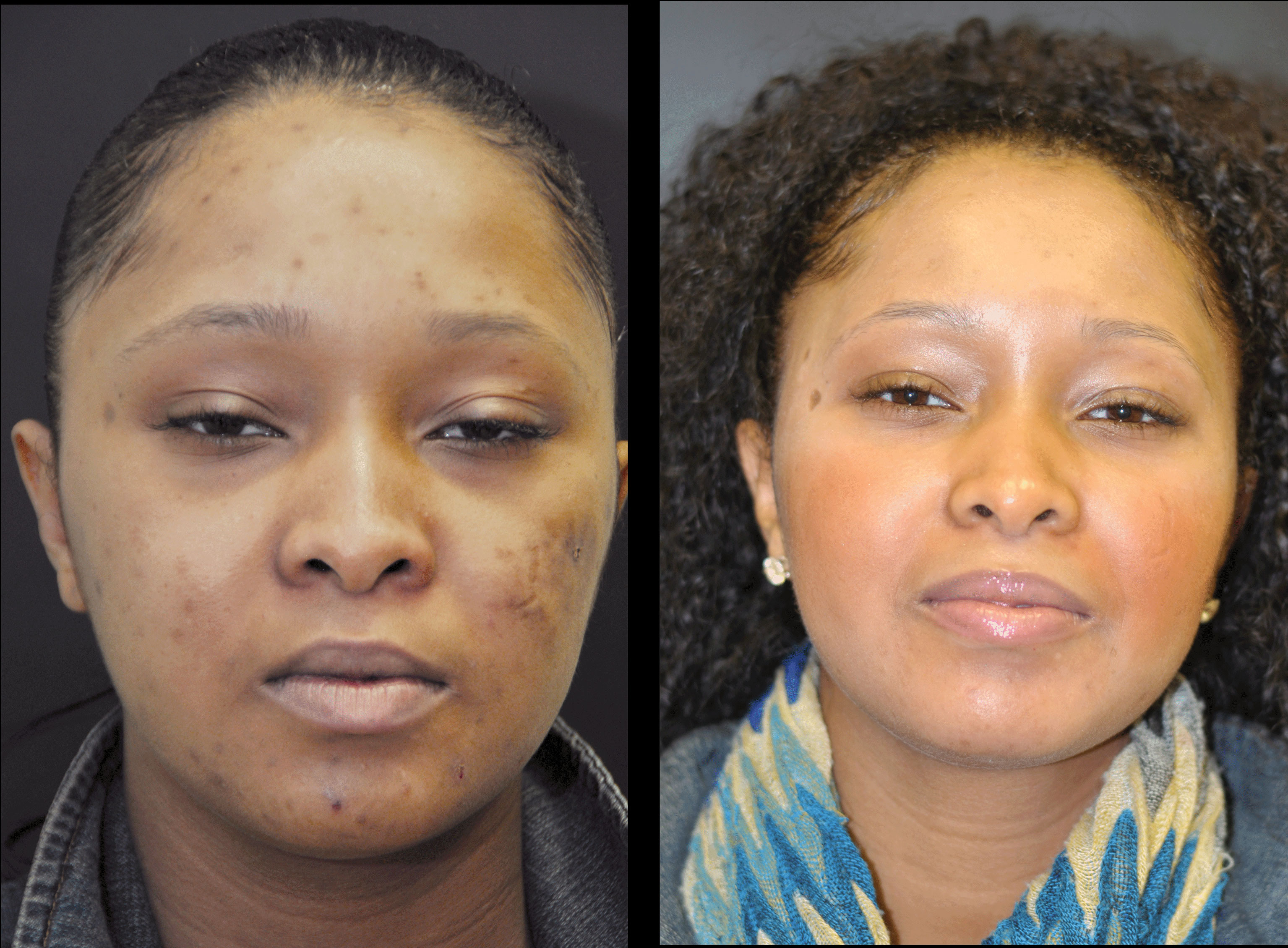 TRETINOIN GEL 0.1% TRETINOIN GEL 0.1%