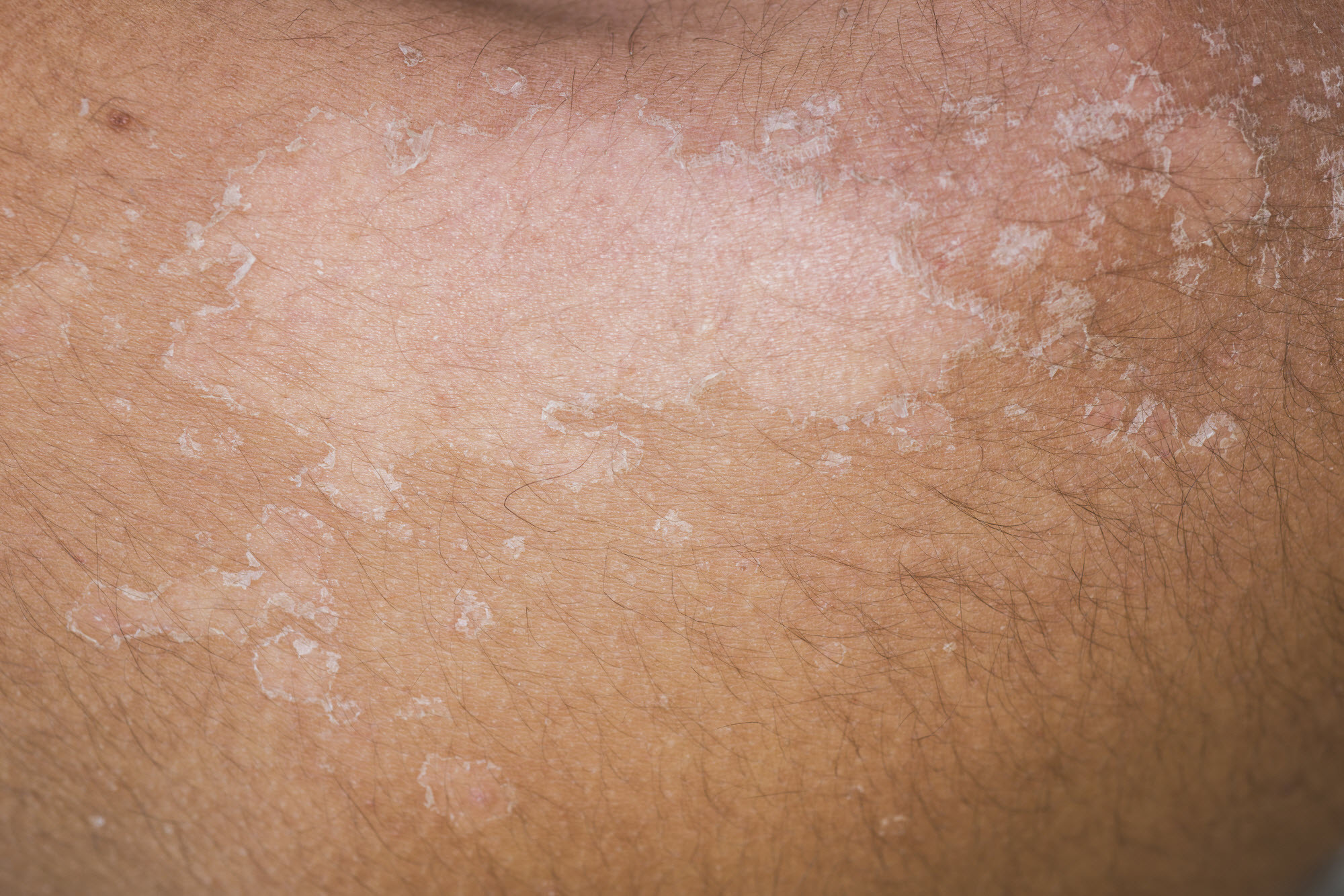 TRETINOIN GEL 0.1% FACE PEEL - Image 8