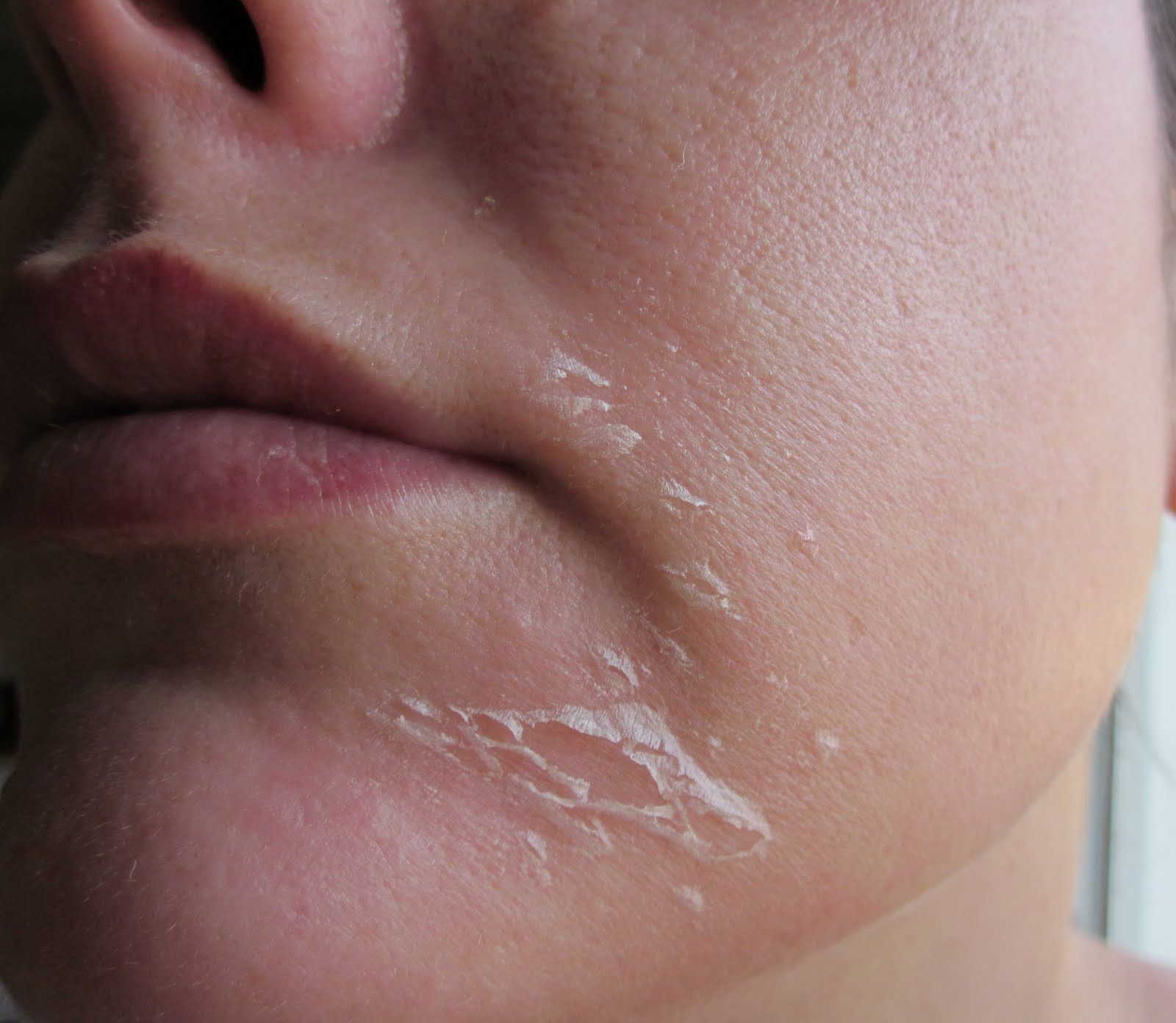 TRETINOIN GEL 0.1% FACE PEEL - Image 5