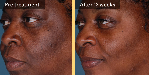 TCA Peel Before & After