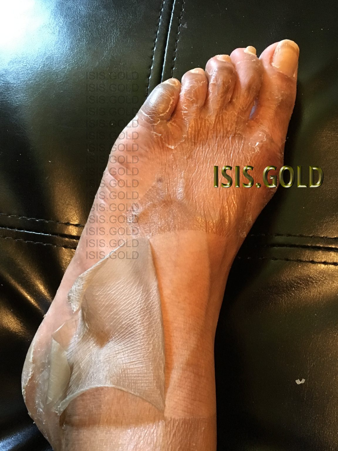 Premium Range of Chemical Peel for Body ISIS.GOLD