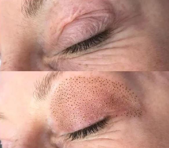 fibroblast plasma pen before and after