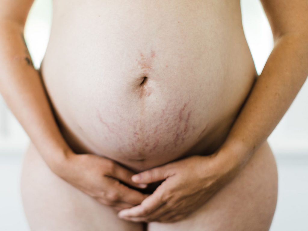 Stretchmarks Post postpartum Belly
