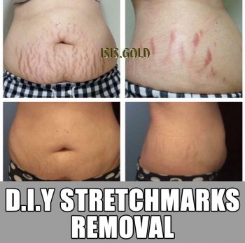 STRETCH MARKS