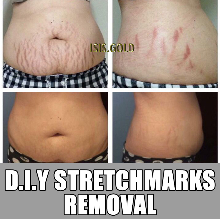 Caucasian woman with stretch marks on her belly before and after, stretch marks before and after, how to get rid of stretch marks, stretch marks removal, stretch mark treatment