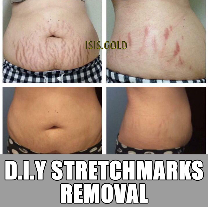 How To Get Rid Of Stretch Marks Permanently Stretch Mark Removal