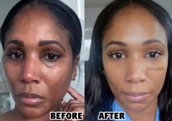 TETRA-C : ANTI-AGING SKIN BLEACH (customized)